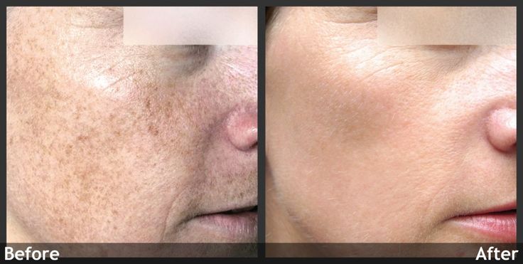Planet Eden Glycolic Acid Skin Peel with Fan Brush - 30%-70% CLINICAL STRENGTH image 5