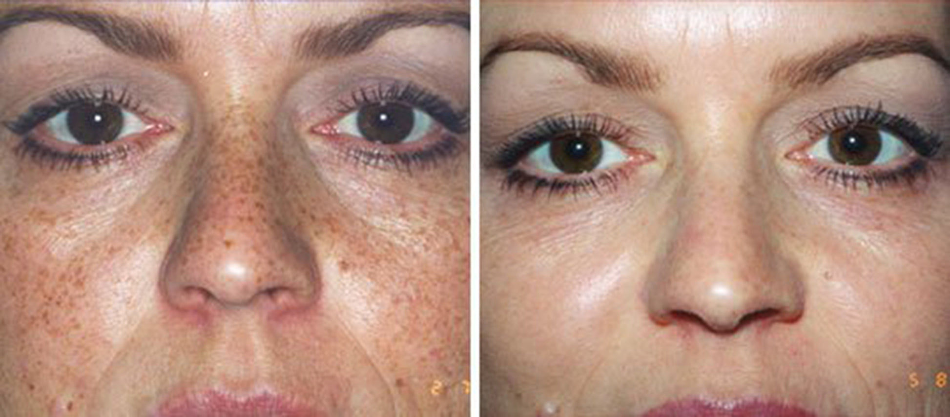 15% TCA Skin Chemical Face Facial Peel - Age Spots- Sun Damage image 3