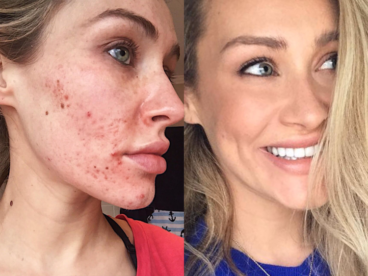 Planet Eden Xfoliate & Glow Salicylic Skin Peel for Fast Clearing of Acne