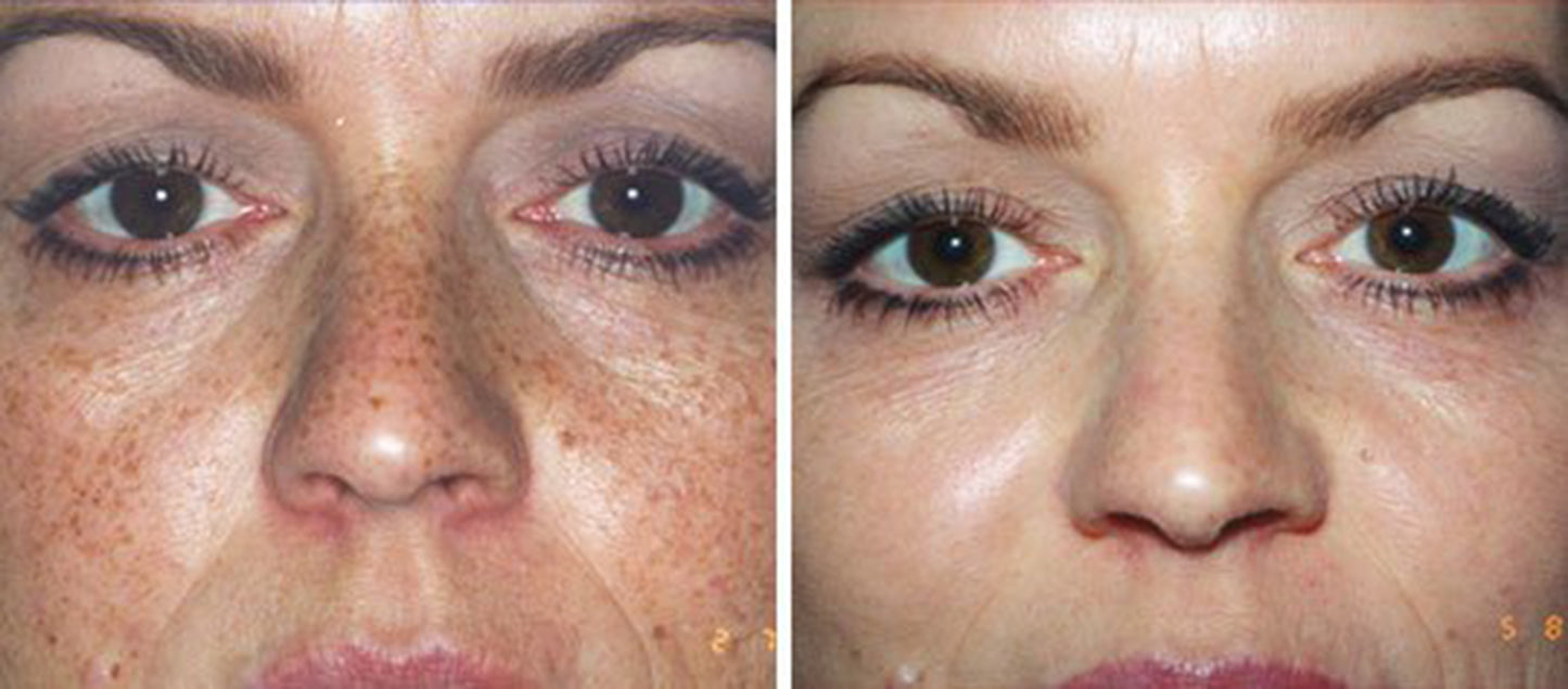 25% TCA Skin Chemical Face Facial Peel - Acne Scars, Sun Damage Hyperpigmentatio image 3