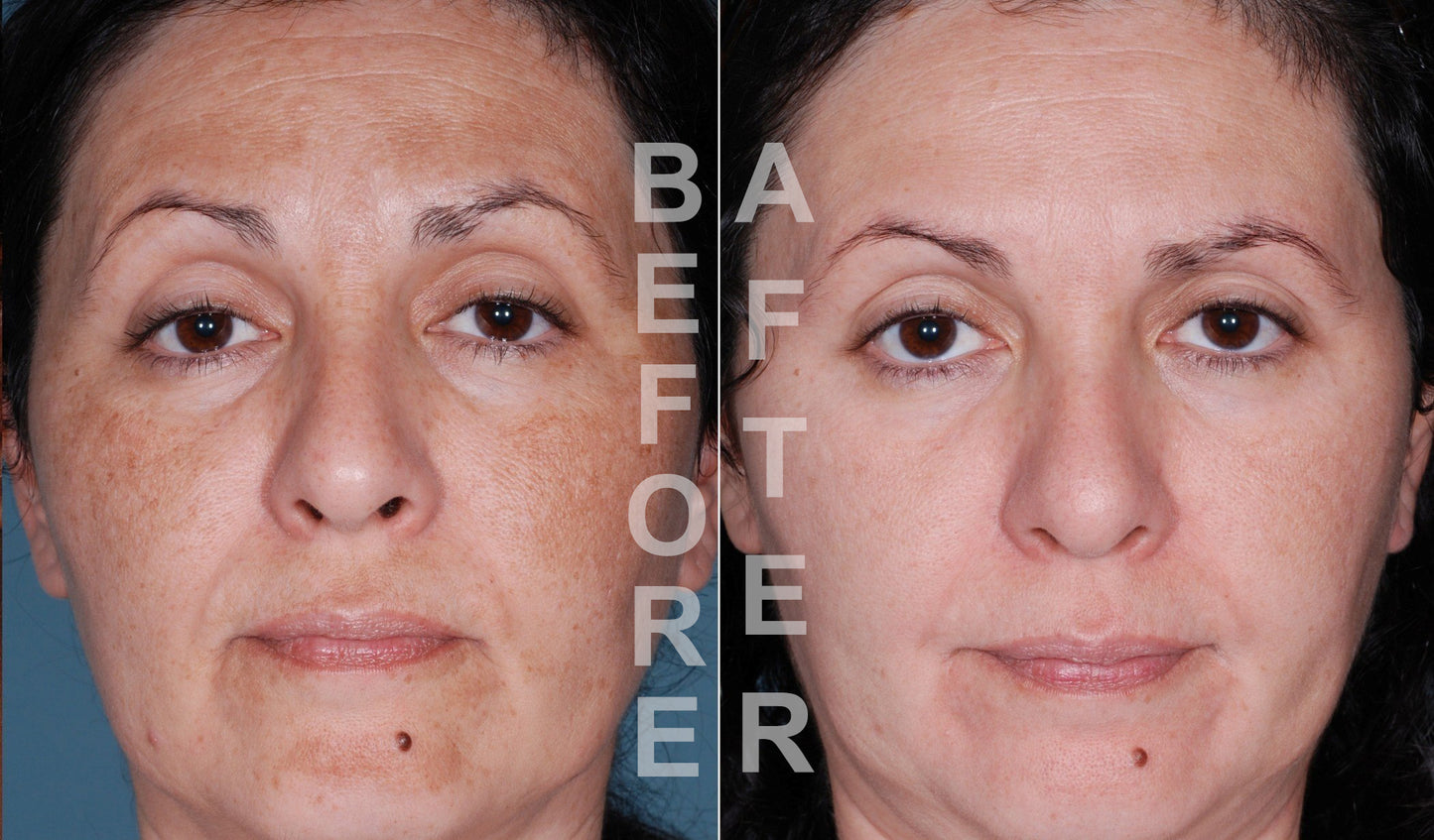 15% TCA Skin Chemical Face Facial Peel + Antioxidant Recovery Cream