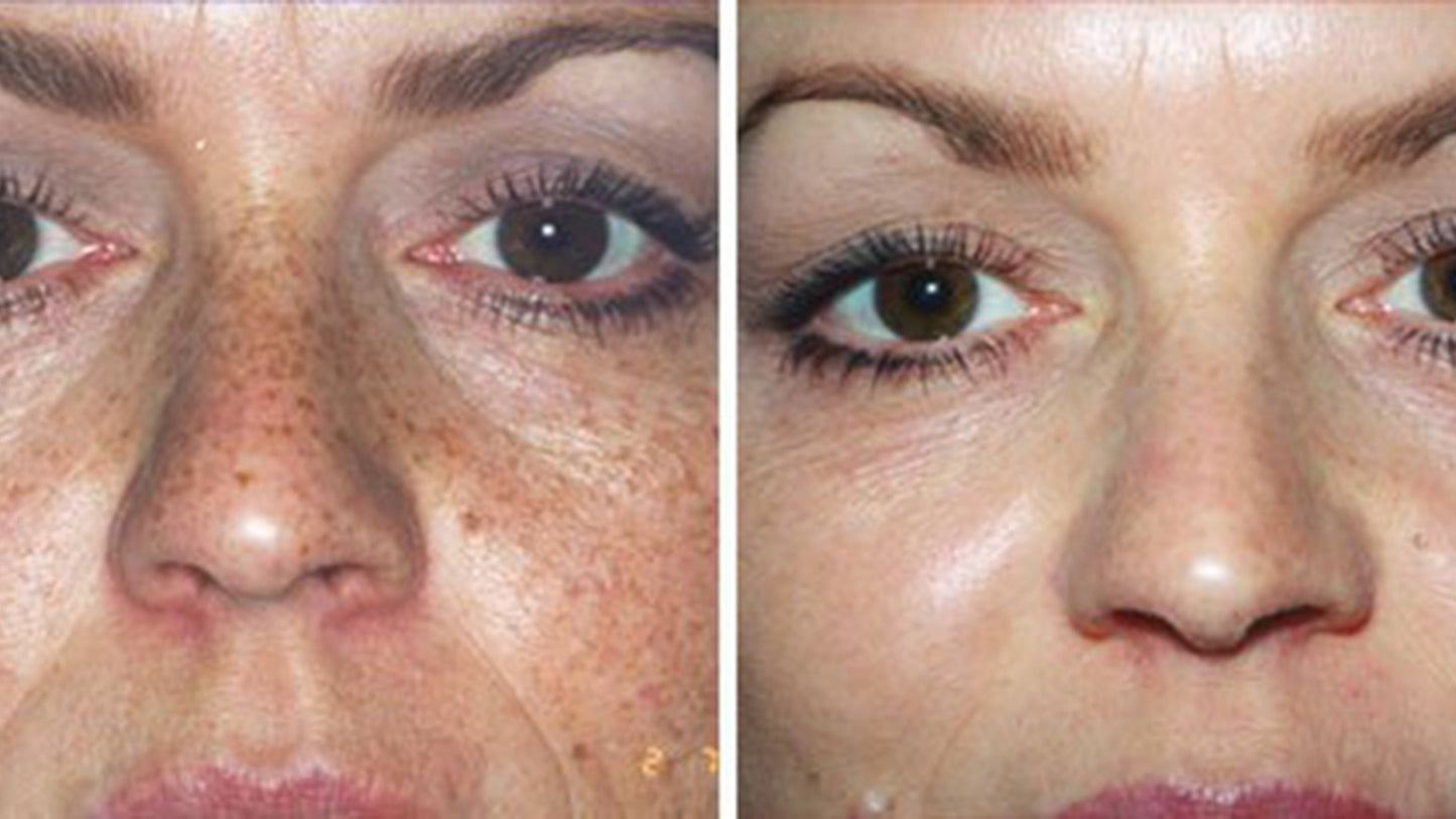 25% TCA Skin Facial Peel- Glycolic Pre-Peel Cleanser + Recovery Cream Kit image 2