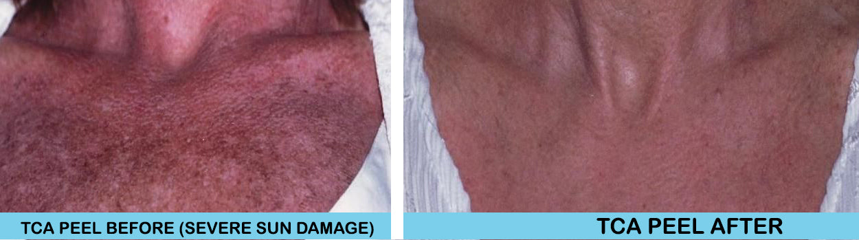 25% TCA Skin Facial Peel- Glycolic Pre-Peel Cleanser + Recovery Cream Kit image 3